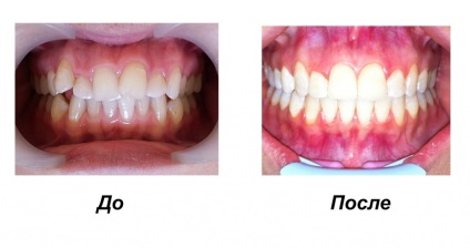 Bretele - stomatologie d. Stomatologie g