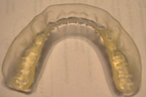 Bruxism - recenzii despre tratament - despre interes