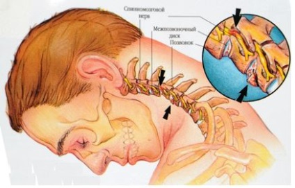 Cauzele cervicocraniului, simptomele, diagnosticul și tratamentul