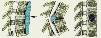 Cauzele cervicocraniului, simptomele, diagnosticul și tratamentul