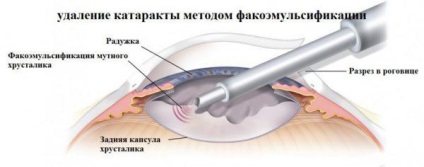 Care sunt simptomele gâtului și cataractei, tratamentul, prevenirea, semnele secundare și primare, cum ar fi