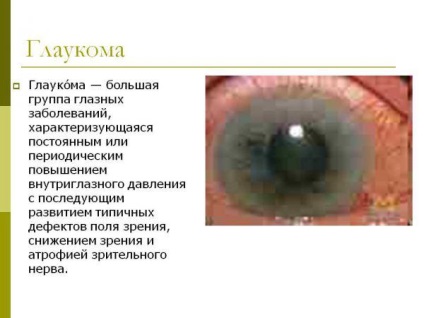 Care sunt simptomele gâtului și cataractei, tratamentul, prevenirea, semnele secundare și primare, cum ar fi