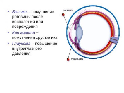 Що таке більмо і катаракта симптоми, лікування, профілактика, ознаки вторинної та первинної, як