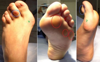 Deformarea tipurilor de picior, tratament