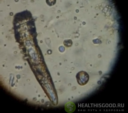 Tratamentul demodex al pielii facială, calea spre sănătate