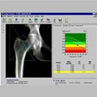 Densitometria și osteoporoza