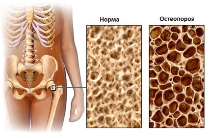 Дензитометрия и Остеопорозата