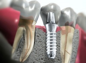 Implantarea dentară a dinților la Moscova