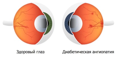 Діабетична ангіопатія судин сітківки ока - ознаки та ефективні методи лікування!