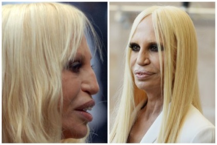 Donatella Versace, ca steaua privită înainte și după operațiunile din plastic