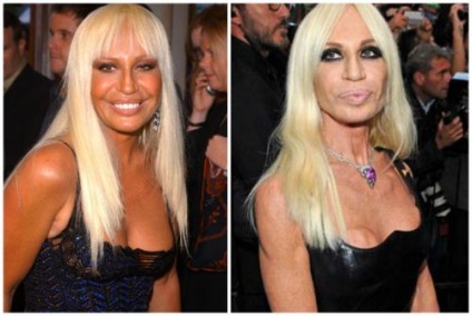 Donatella Versace, ca steaua privită înainte și după operațiunile din plastic
