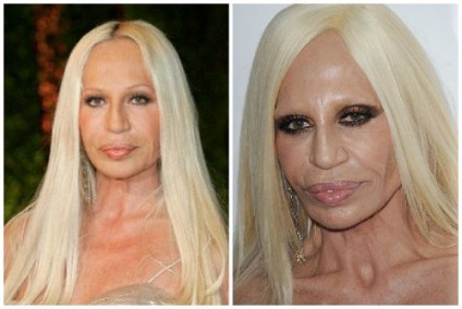 Donatella Versace, ca steaua privită înainte și după operațiunile din plastic