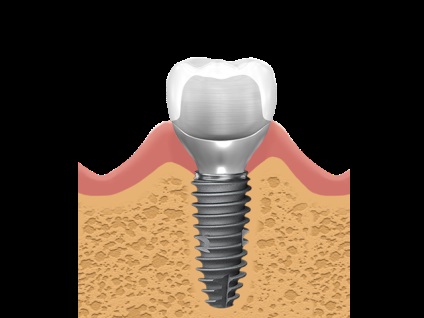 Elite club dentar