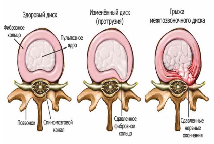 Simulator eliptic cu o hernie a coloanei vertebrale lombare - un forum despre coloana vertebrală, nu o minciună -