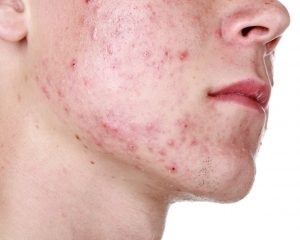 Herpes erupții pe tipuri de piele, tratament, caracteristici