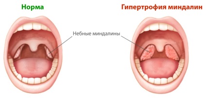 Hypertrofia amigdalelor nazofaringiene - tratamentul bolilor la nivelul gâtului și nasului