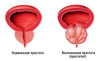 Головні симптоми і термінове лікування хронічного простатиту будинку народними засобами