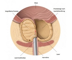 Principalele simptome și tratamentul urgent al prostatitei cronice la domiciliu cu remedii folclorice