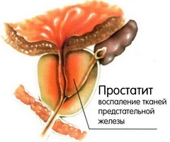 Principalele simptome și tratamentul urgent al prostatitei cronice la domiciliu cu remedii folclorice