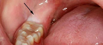 Горизонтальний зуб мудрості - причини горизонтального зростання вісімки, методи лікування та видалення