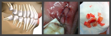 Orizontală dinte de înțelepciune - cauze de creștere orizontală a cifrei opt, metode de tratament și îndepărtare