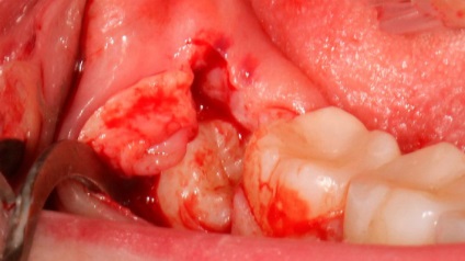 Orizontală dinte de înțelepciune - cauze de creștere orizontală a cifrei opt, metode de tratament și îndepărtare