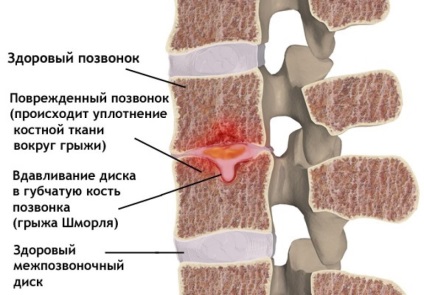 SHmorlja hernie - ceea ce este și modul de a trata și diagnostica ceea ce RMN-ul va arata hernie SHmorlja