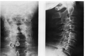 SHmorlja hernie - ceea ce este și modul de a trata și diagnostica ceea ce RMN-ul va arata hernie SHmorlja