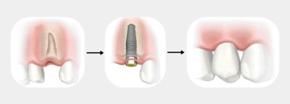 Implantare, leu alb