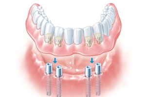 Implantare, leu alb