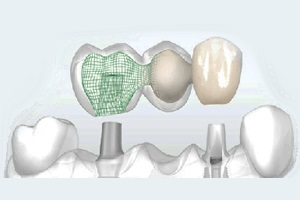 Implantare, leu alb