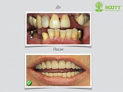 Implantul de dinți în Kursk ieftin, recenzii, fotografii