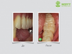 Імплантація зубів в Курську недорого, відгуки, фото