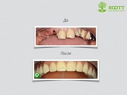 Імплантація зубів в Курську недорого, відгуки, фото