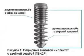 Implants ards - prețuri, recenzii