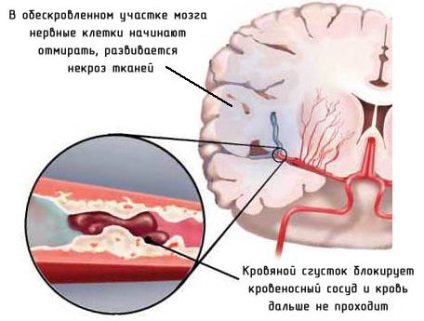 Accidente vasculare cerebrale și semne de accident vascular cerebral, cauze