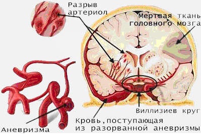 Accidente vasculare cerebrale și semne de accident vascular cerebral, cauze