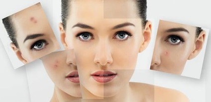 Cum sa scapi de acnee acasa rapid si eficient
