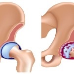 Який лікар лікує коксартроз кульшового суглоба