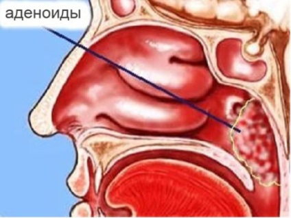 Як правильно лікувати кашель при аденоїдах, горлор