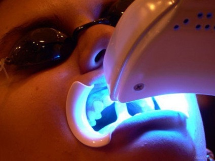 Cum se efectuează albirea dinților laser?