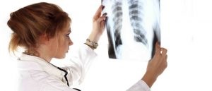 Cum arată semnele de raze X ale cancerului pulmonar?