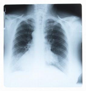 Cum arată semnele de raze X ale cancerului pulmonar?