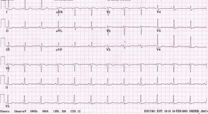 Cardiologii au aflat cum să prevină impotența