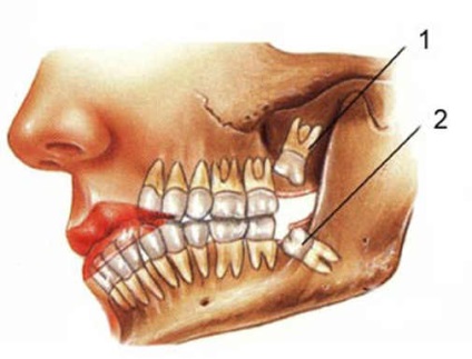 Карієс між зубами