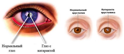 Simptome de cataractă, tratament