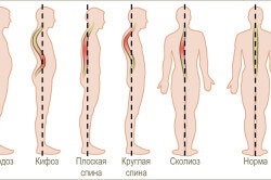 Kyphoscoliosis a mellkasi gerinc okoz, a tünetek és a kezelés (videó)