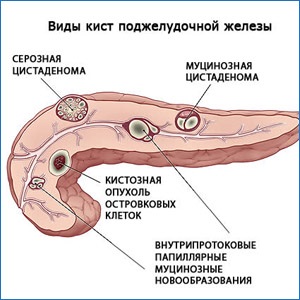 Chistul pancreasului, tipurile de chisturi și tratamentul