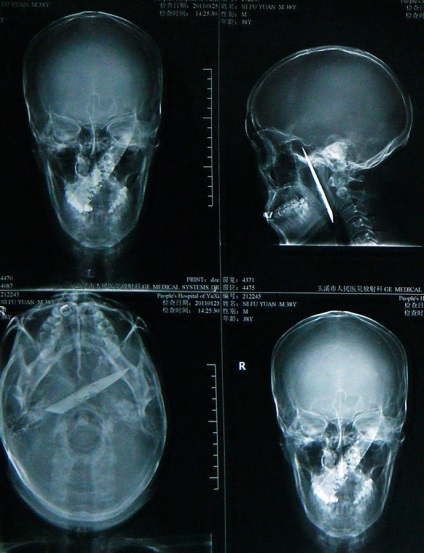 Egy kínai férfi élt négy évig egy késsel a koponyáját - hírek képekben