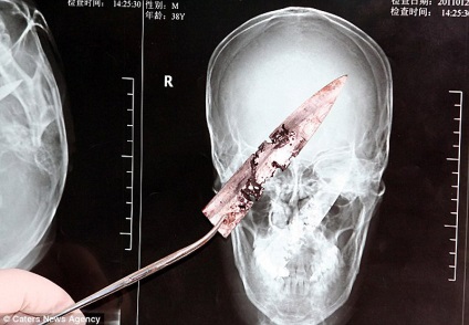 Един китайски човек е живял в продължение на четири години с нож в главата му - новини в снимки